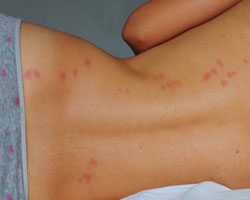 bed bugs