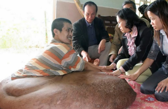 80kg, 1m-wide tumour