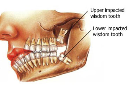 wisdom-tooth