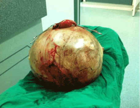 tumour