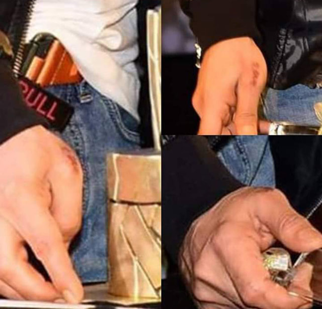 See… Shah Rukh’s burnt hand!